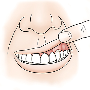 Closeup of mouth with finger lifting upper lip to show evened-out gumline after surgery.