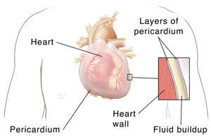 Front view of male chest showing heart and lungs with inset showing pericardial effusion. 