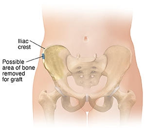 Front view of female lower abdomen showing pelvic bones. Blue area shows possible bone graft donor site.