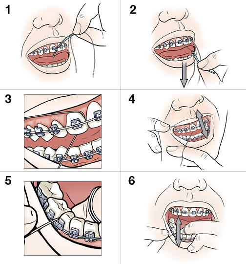 6 pasos para limpiarse los dientes y frenos con hilo dental