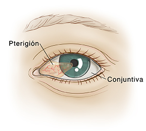 Vista frontal de un ojo donde puede verse tejido transparente que crece por encima de la parte blanca del ojo y sobre la pupila.