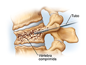 Vista lateral de vértebras y discos comprimidos. Se inserta una aguja en la parte posterior de la vértebra hasta el cuerpo vertebral.