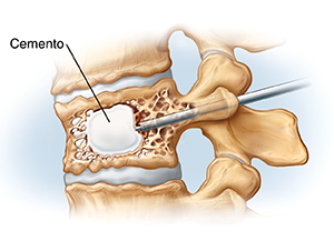 Vista lateral de vértebras y discos comprimidos. Se inserta una aguja en la parte posterior de la vértebra hasta el cuerpo vertebral y se inyecta cemento óseo en el espacio libre hecho por el balón.