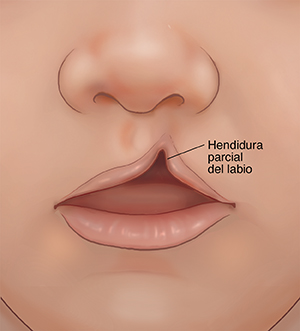 Primer plano de un bebé con labio leporino parcial. 