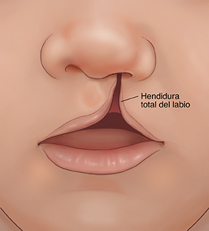 Primer plano de la boca de un bebé con labio leporino total.