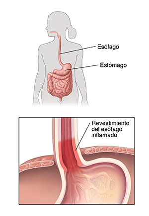 Contorno de una figura humana que muestra el aparato digestivo, donde se destacan el esófago y el estómago. Detalle en primer plano del esófago inferior, donde se conecta con el estómago. El recubrimiento del esófago está inflamado.