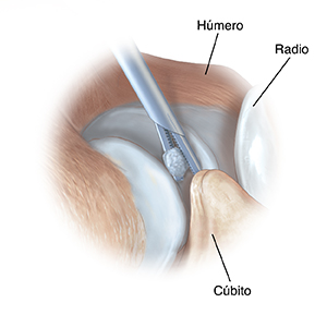 Vista lateral de la articulación del codo donde puede verse un instrumento que extrae un cuerpo suelto.