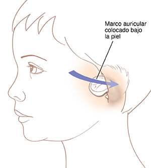 Vista lateral de una cabeza en la que se observa la inserción de un marco de cartílago para la oreja colocado debajo de la piel en el lugar donde irá la oreja nueva.