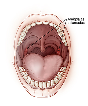Boca abierta que muestra unas amígdalas inflamadas.