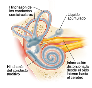 Corte transversal del oído donde puede verse la cóclea con enfermedad de Meniere.
