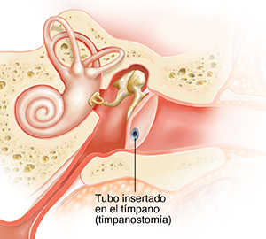 Corte transversal del oído de un niño donde puede verse líquido en el oído medio y la trompa de Eustaquio inflamada, otitis media aguda (OMA). Tubo insertado en el tímpano.