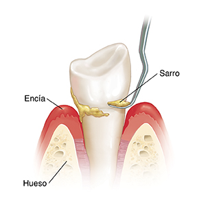 Vista lateral de un diente en el hueso y un instrumento haciendo raspado dental.