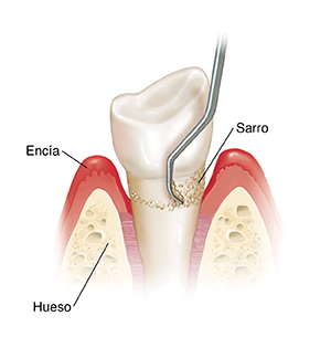 Vista lateral de un diente en el hueso y un instrumento haciendo alisado radicular.