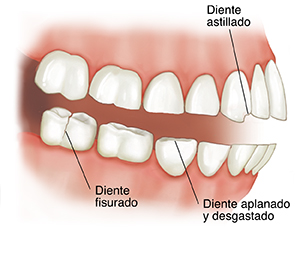 Vista lateral de los dientes y la mandíbula donde se observa un diente partido, un diente astillado y un diente aplanado y desgastado.
