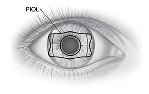 Vista frontal de un ojo en el que se ve la ubicación de la PIOL detrás del iris.