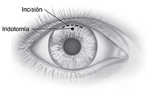 Vista frontal de un ojo en el que se ve una incisión en la parte superior del iris y un orificio de iridotomía.
