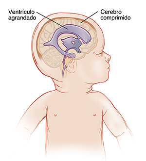 Vista lateral de la cabeza de un bebé donde se observan ventrículos agrandados que comprimen el cerebro.