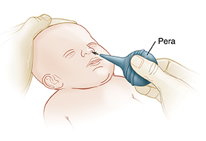 Una mano inserta una pera de goma en la nariz de un bebé. Otra mano sostiene la cabeza del bebé para que esté firme.