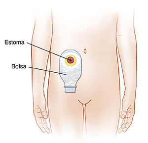 Contorno del abdomen de una niña que muestra la bolsa alrededor del estoma.