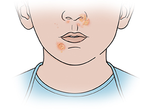 Primer plano de una boca en donde se ven llagas cerca de los labios y alrededor de la nariz.