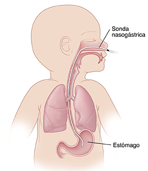Contorno de un bebé para mostrar una sonda nasogástrica en la nariz, a través dentro del estómago.