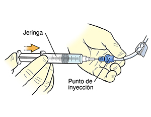 Primer plano de un par de manos enguantadas que usan una jeringa para inyectar la solución en el tapón del punto de inyección del catéter.