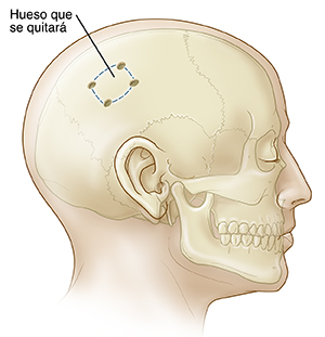 Vista lateral de la cabeza con el cráneo donde se observa el hueso que se extrae en la craniectomía.