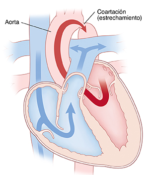 Corte transversal del corazón que muestra la coartación de la aorta.