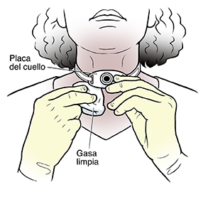 Mujer limpiando la piel alrededor de la sonda de traqueostomía en el cuello.