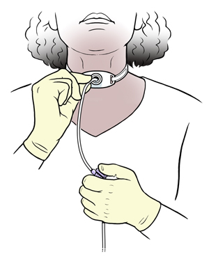 Mujer introduciendo una sonda de aspiración en la cánula de traqueostomía del cuello.