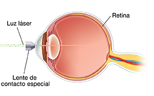 Vista lateral de un ojo que muestra la lente en el frente del ojo. Una luz láser se enfoca en la pared trasera interna del ojo. 