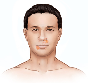 Vista frontal de la cara de un hombre donde se observa un impétigo alrededor de la nariz y la boca.