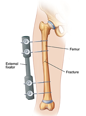 Outline of leg showing external fixator on outside of leg with pins going through skin to hold leg fracture together.