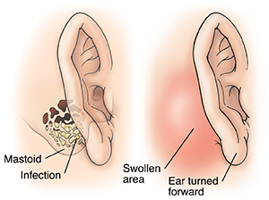 Side view of ear showing infection in mastoid bone. SIde view of ear showing swollen area behind ear, pushing ear forward.